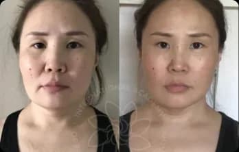 Swelling has disappeared from the face, making it look younger and slimmer.
